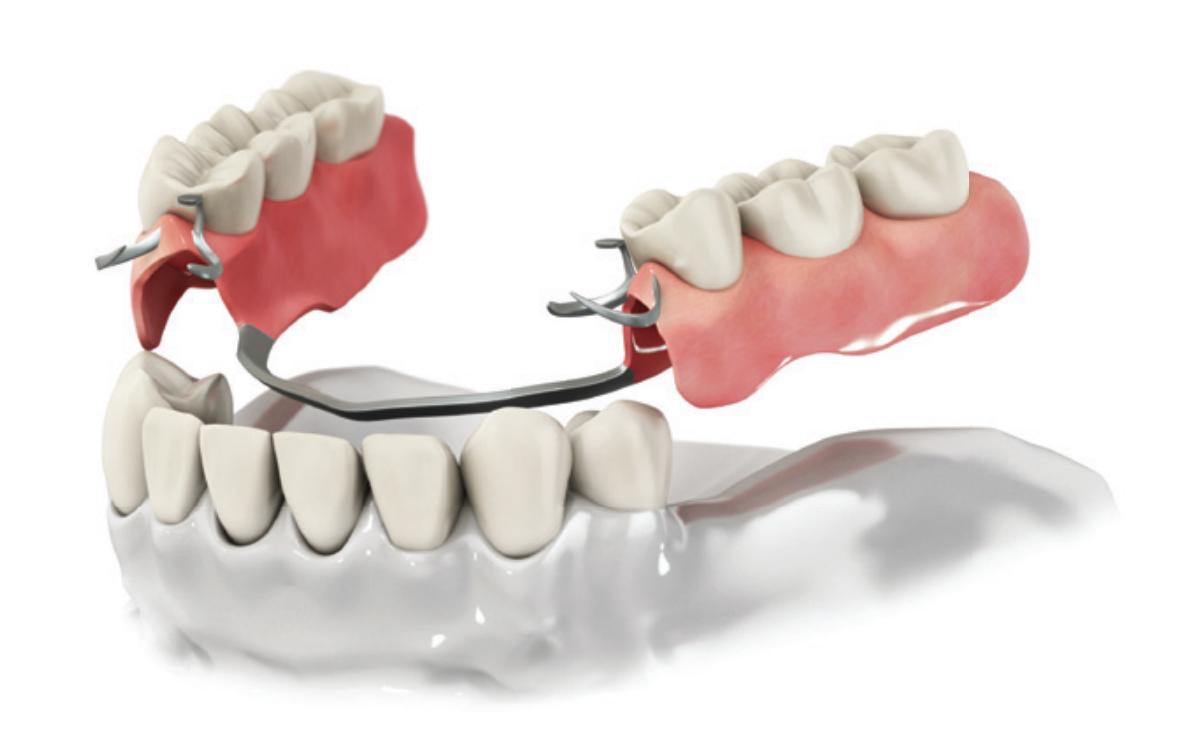 Виды протезирования выбирают при частичном отсутствии зубов