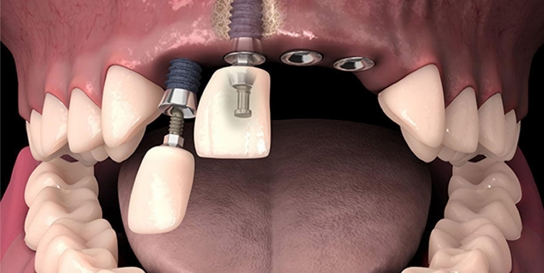 Как делают имплантацию зубов