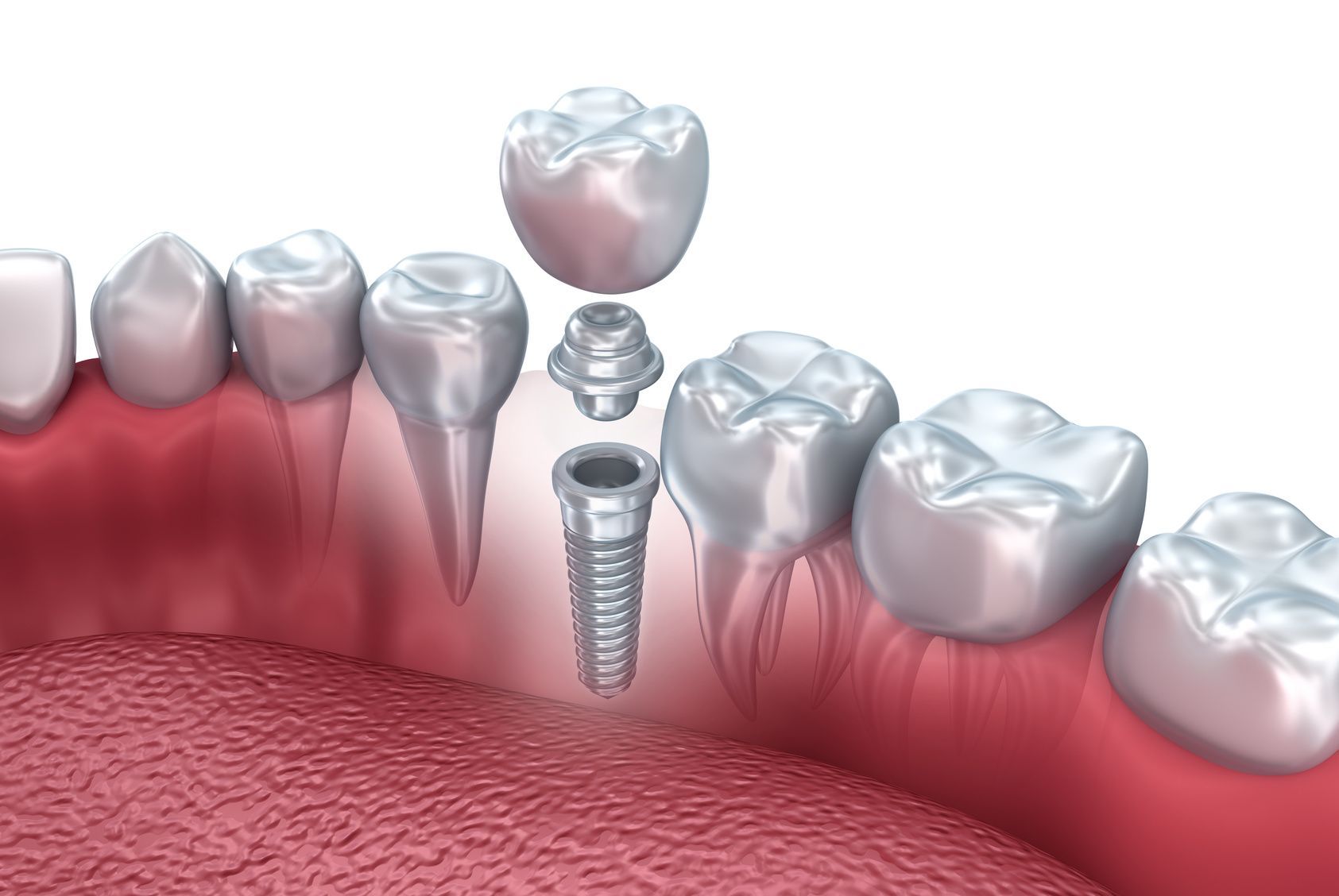 Как долго приживаются зубные импланты