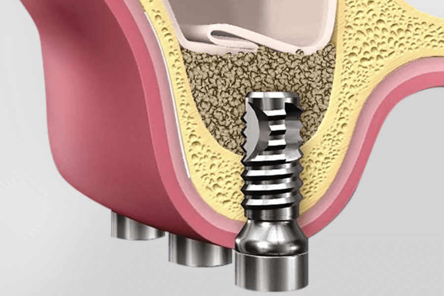 Имплантация зубов и костная пластика