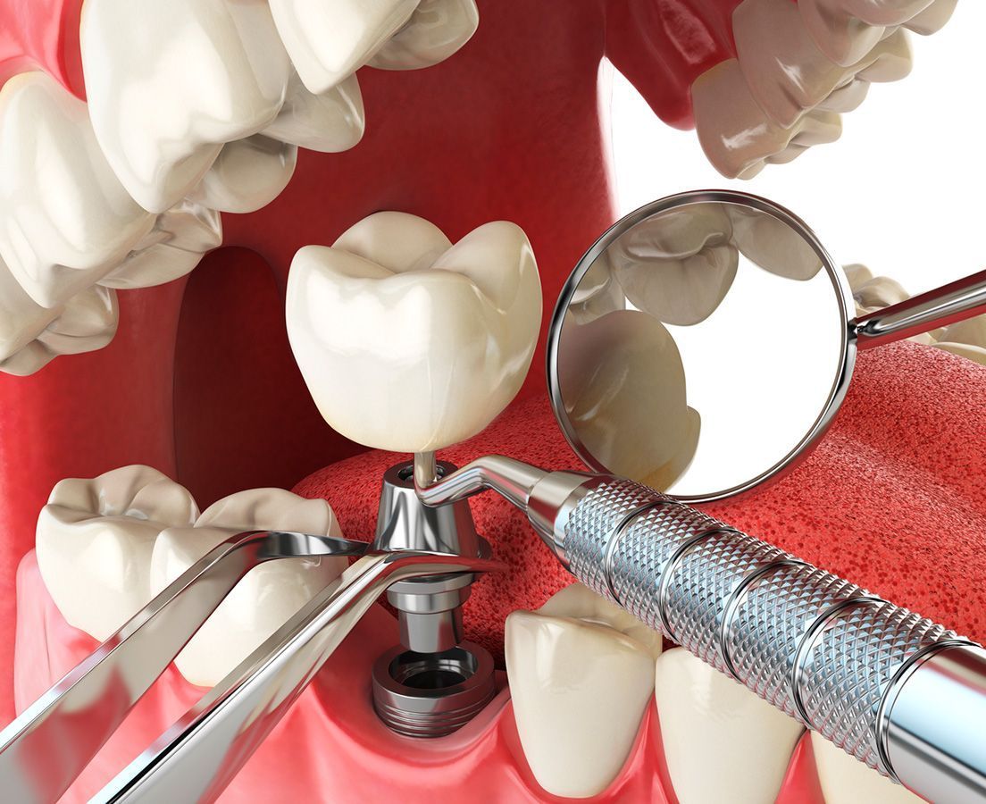 Как проходит имплантация зуба: этапы процедуры