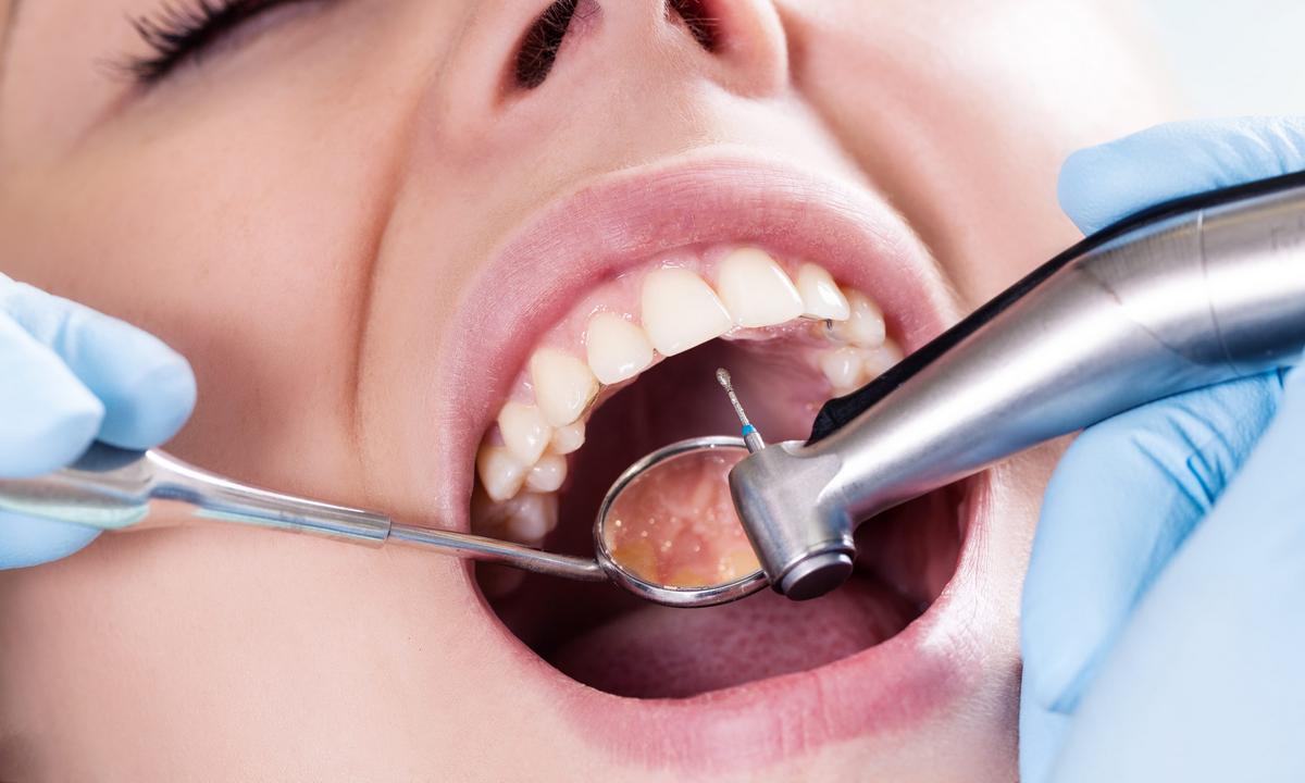 Лечение кариеса зубов у взрослых и детей