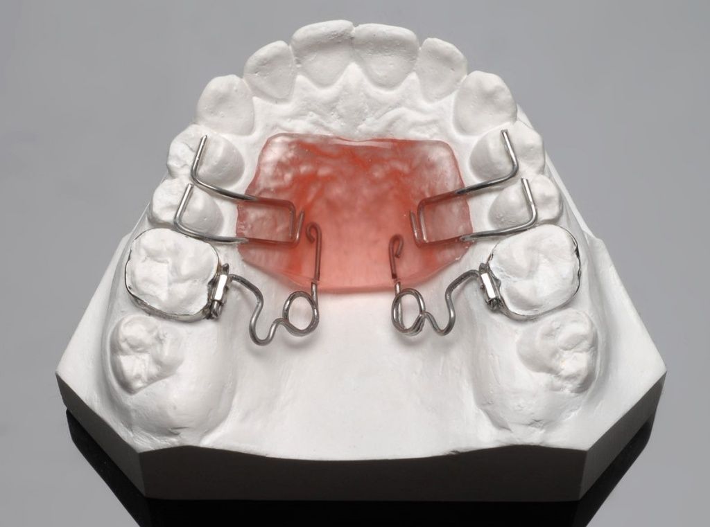 ALF ортодонтия: лечение расширяющими дугами