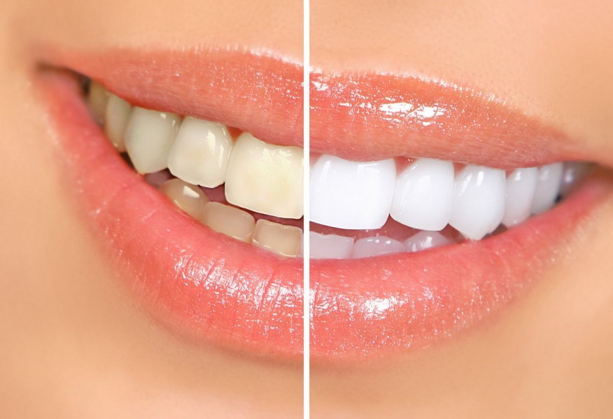 В чем вред и польза отбеливания зубов? Честно о популярной процедуре