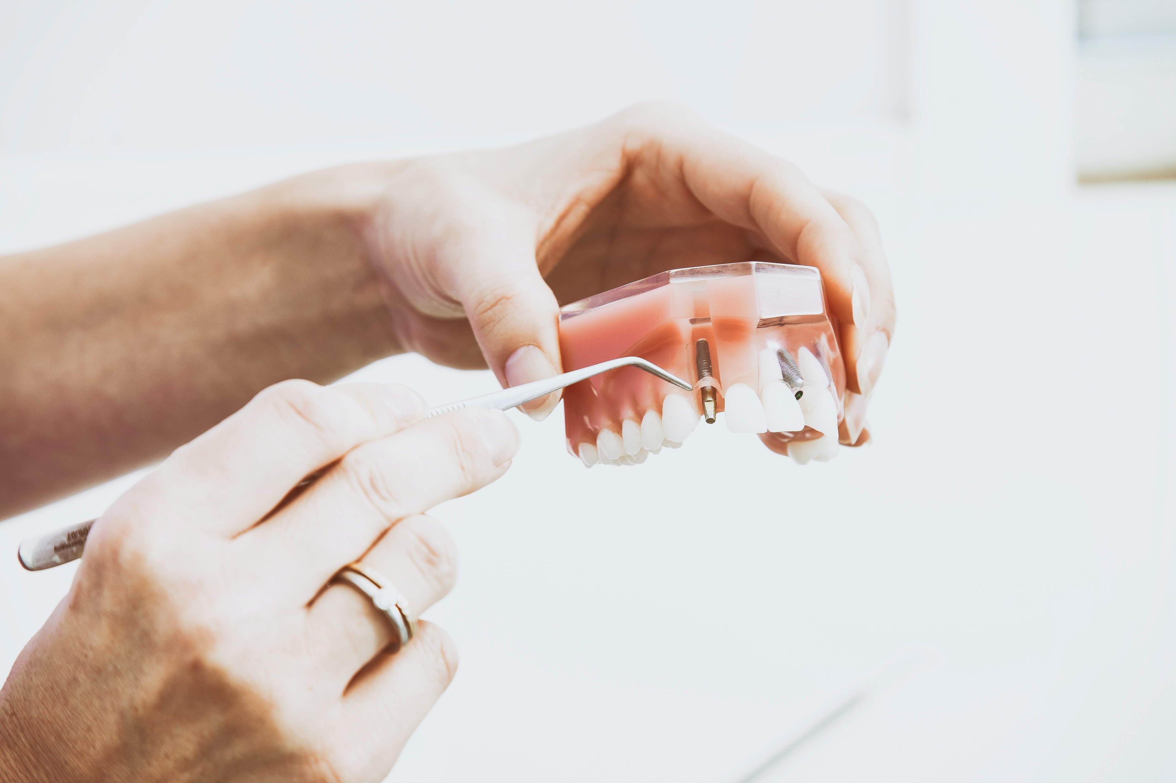 Современные зубные импланты
